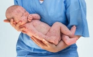 Measles: Causes and Treatment
