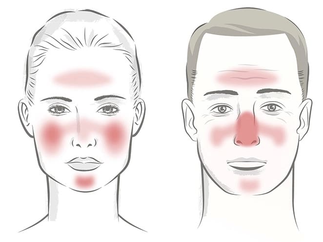 Does Rosacea Ever Go Away?
