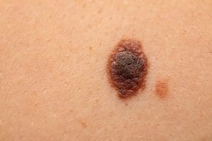 Treatment for Non-Melanoma Skin Cancers