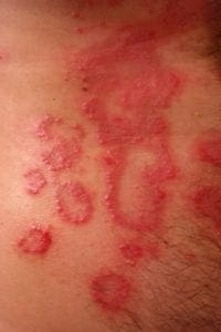 Common Causes of Skin Rashes in Children & Adults