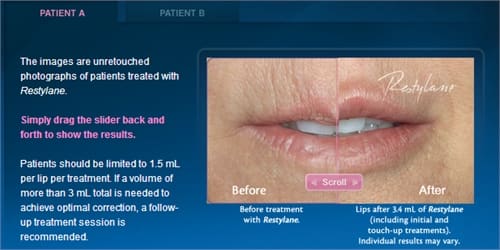 Restylane Dermal Filler Before & After Photos