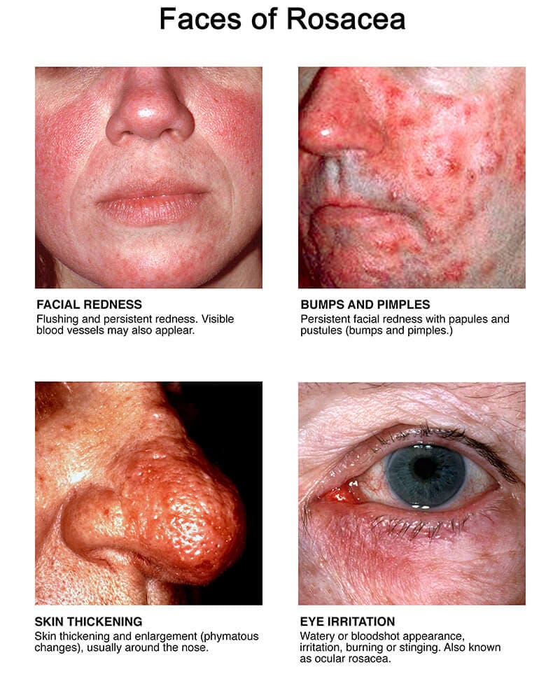 Is Rosacea Contagious?