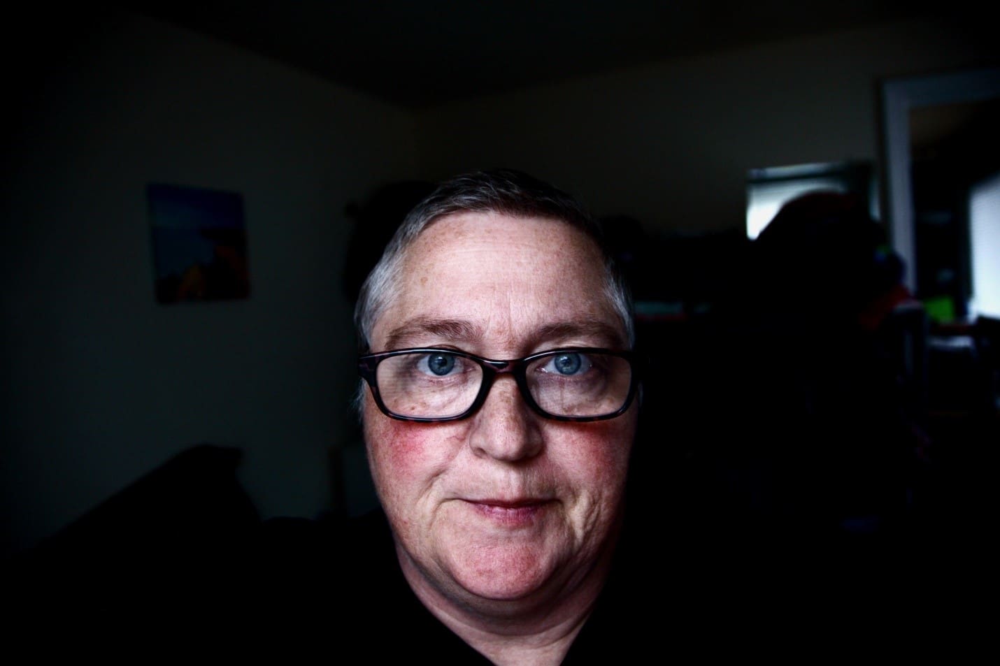 3 Tips for People with Rosacea