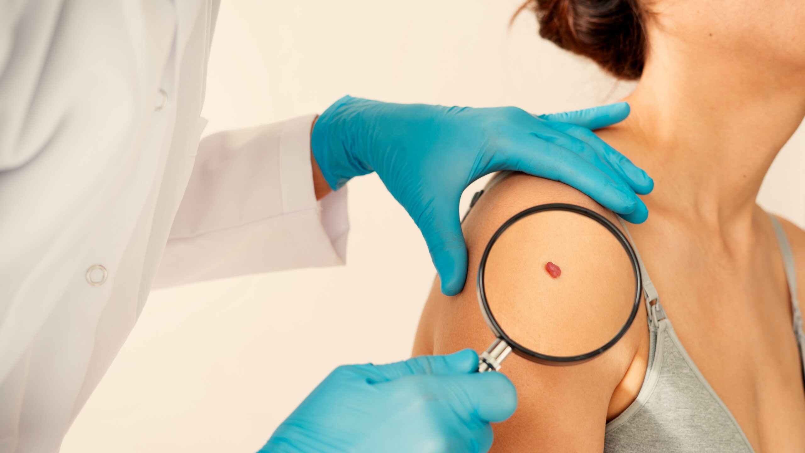 Dermatologist examining a suspicious mole on a patient’s shoulder with a magnifying glass to identify possible types of skin cancer.