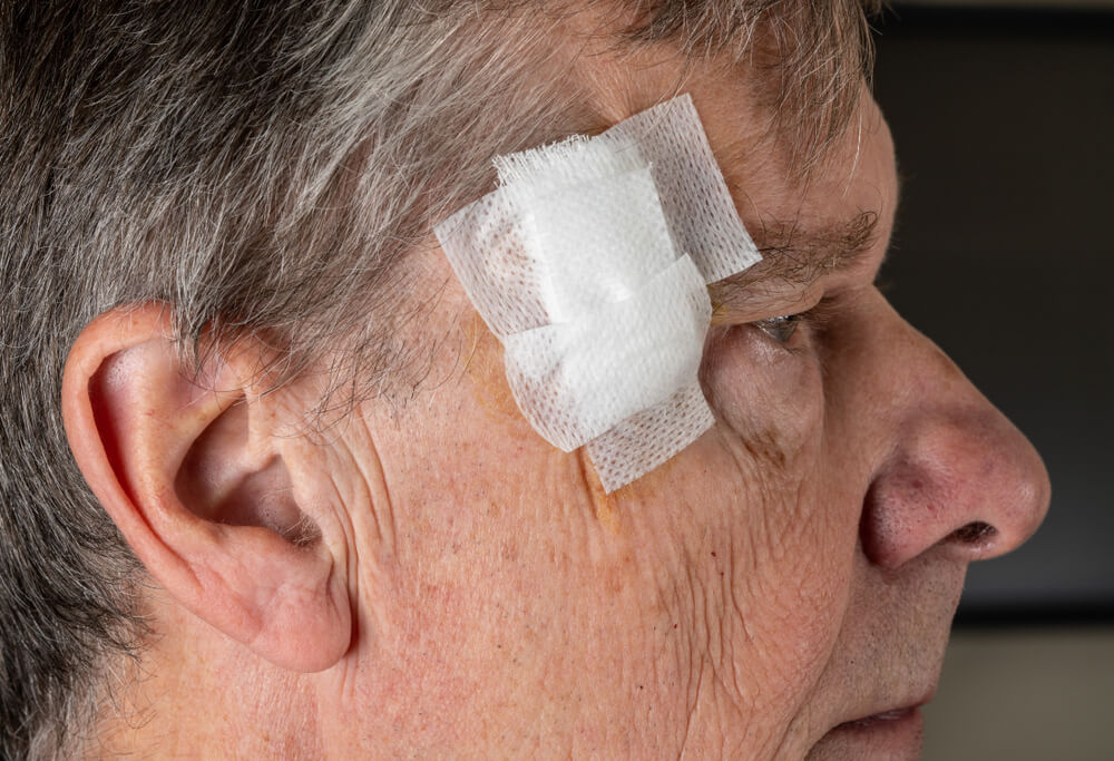 Wound healing after Mohs surgery
