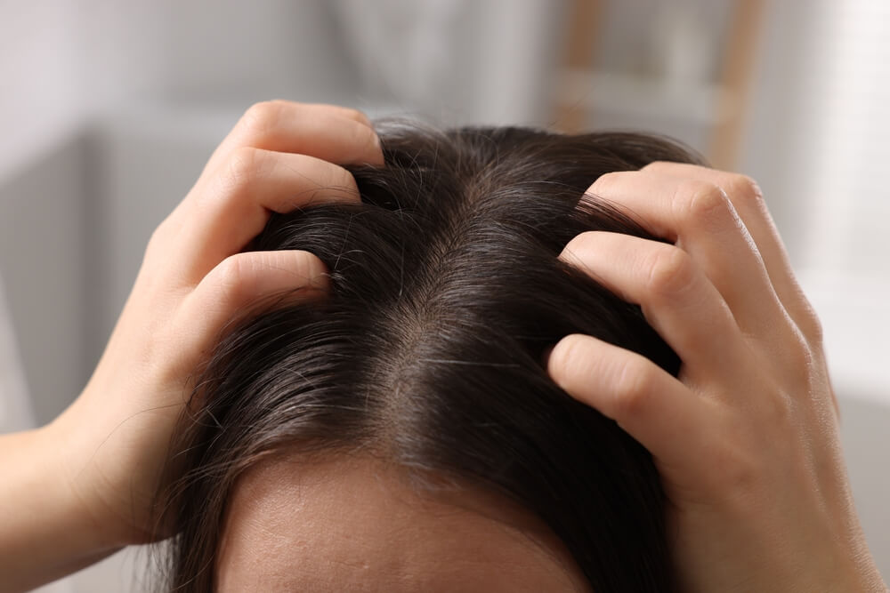 Woman scratching her itchy scalp with visible flaking at the hairline